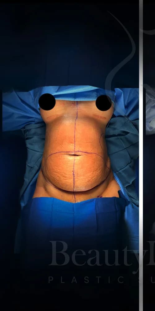 Abdominoplastia antes por Dr. Anne-Sophie Lessard en Miami · Beautyland Plastic Surgery