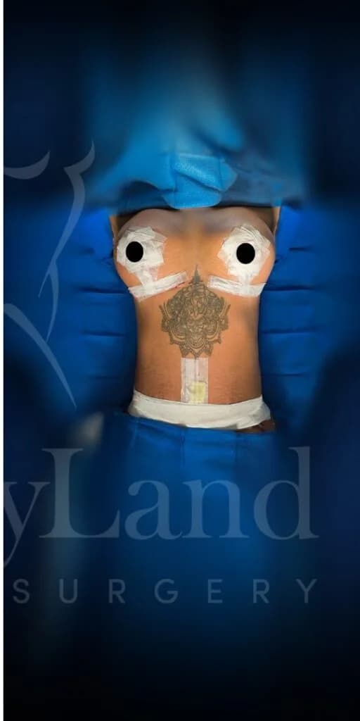 Abdominoplastia después por Dr. Oliver Simmons en Miami · Beautyland Plastic Surgery