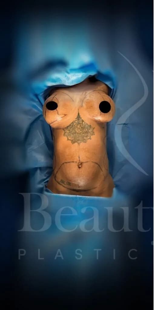 Abdominoplastia antes por Dr. Oliver Simmons en Miami · Beautyland Plastic Surgery