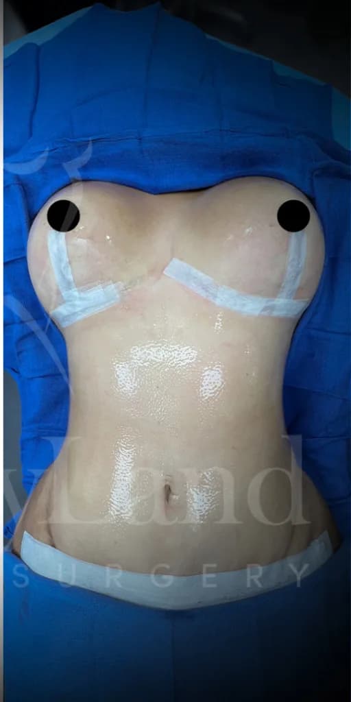 Abdominoplastia después por Dr. Oliver Simmons en Miami · Beautyland Plastic Surgery