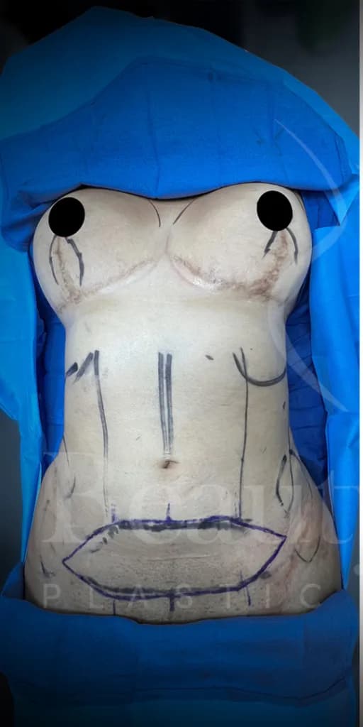 Abdominoplastia antes por Dr. Oliver Simmons en Miami · Beautyland Plastic Surgery