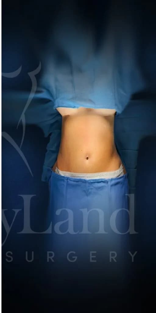 Abdominoplastia después por Dr. Oliver Simmons en Miami · Beautyland Plastic Surgery