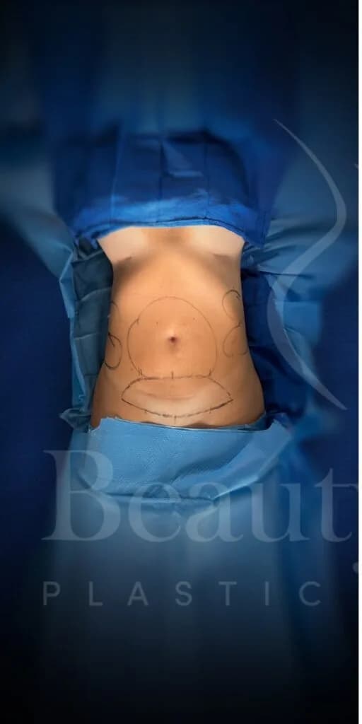 Abdominoplastia antes por Dr. Oliver Simmons en Miami · Beautyland Plastic Surgery