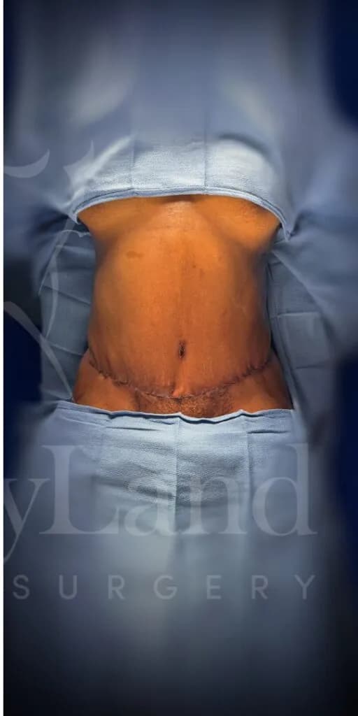 Abdominoplastia después por Dr. Oliver Simmons en Miami · Beautyland Plastic Surgery
