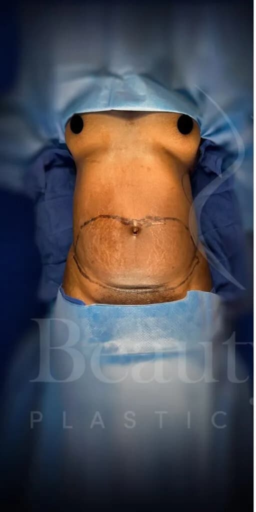 Abdominoplastia antes por Dr. Oliver Simmons en Miami · Beautyland Plastic Surgery