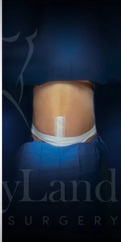 Abdominoplastia después por Dr. Oliver Simmons en Miami · Beautyland Plastic Surgery