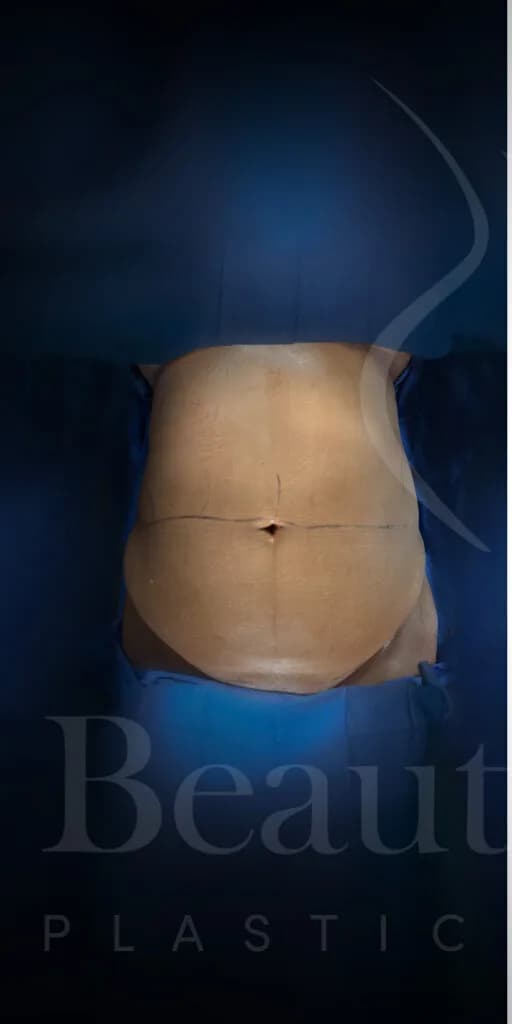 Abdominoplastia antes por Dr. Oliver Simmons en Miami · Beautyland Plastic Surgery