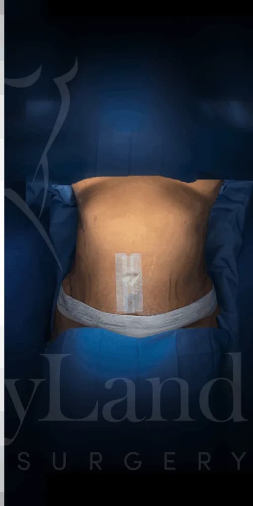 Abdominoplastia después por Dr. Oliver Simmons en Miami · Beautyland Plastic Surgery