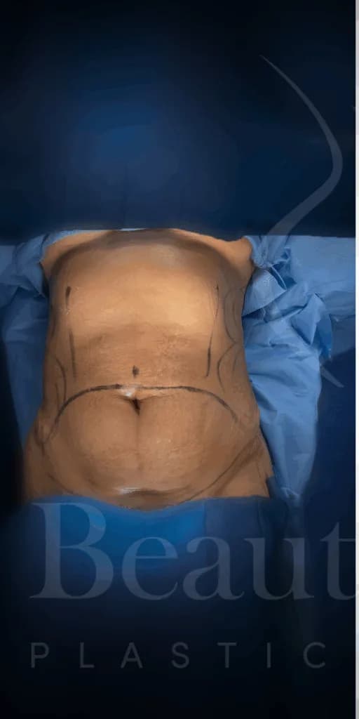 Abdominoplastia antes por Dr. Oliver Simmons en Miami · Beautyland Plastic Surgery