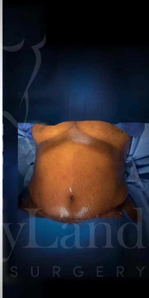 Abdominoplastia después por Dr. Oliver Simmons en Miami · Beautyland Plastic Surgery