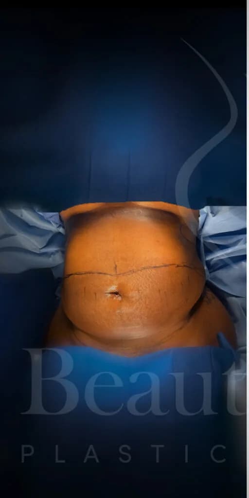 Abdominoplastia antes por Dr. Oliver Simmons en Miami · Beautyland Plastic Surgery