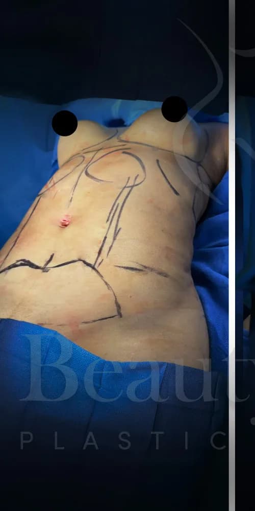 Abdominoplastia antes por Dr. Oliver Simmons en Miami · Beautyland Plastic Surgery