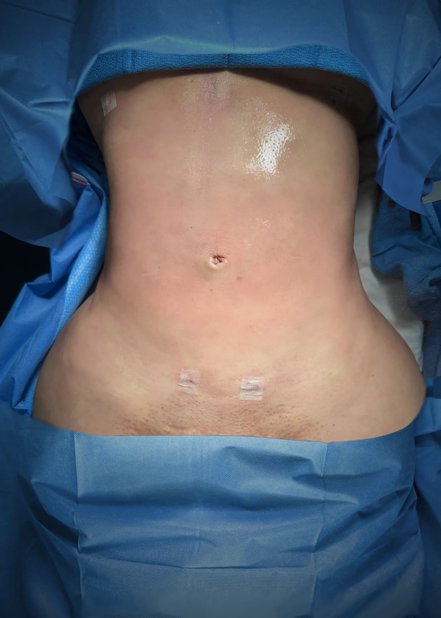 Liposuction & Lipo 360 after by Dr. Christopher J. Salgado in Miami · Beautyland Plastic Surgery
