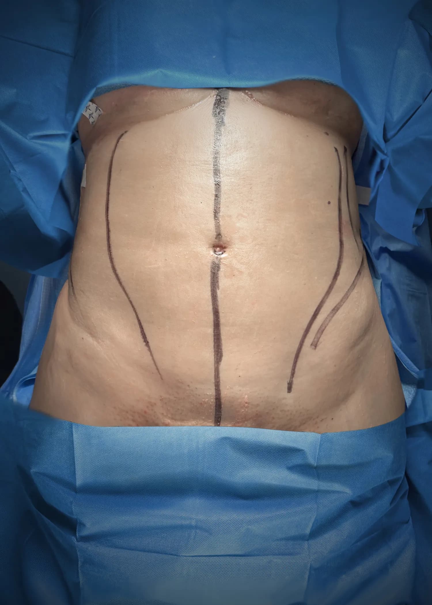 Liposuction & Lipo 360 before by Dr. Christopher J. Salgado in Miami · Beautyland Plastic Surgery