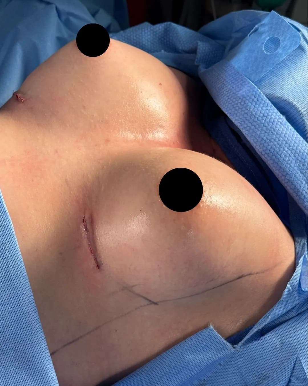 Breast Augmentation after by Dr. Anne-Sophie Lessard in Miami · Beautyland Plastic Surgery