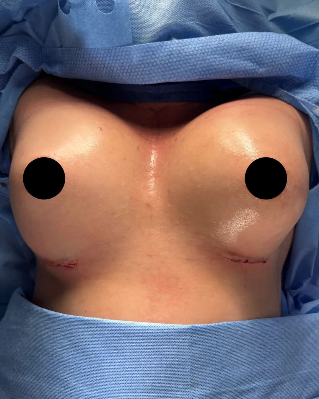 Breast Augmentation after by Dr. Anne-Sophie Lessard in Miami · Beautyland Plastic Surgery