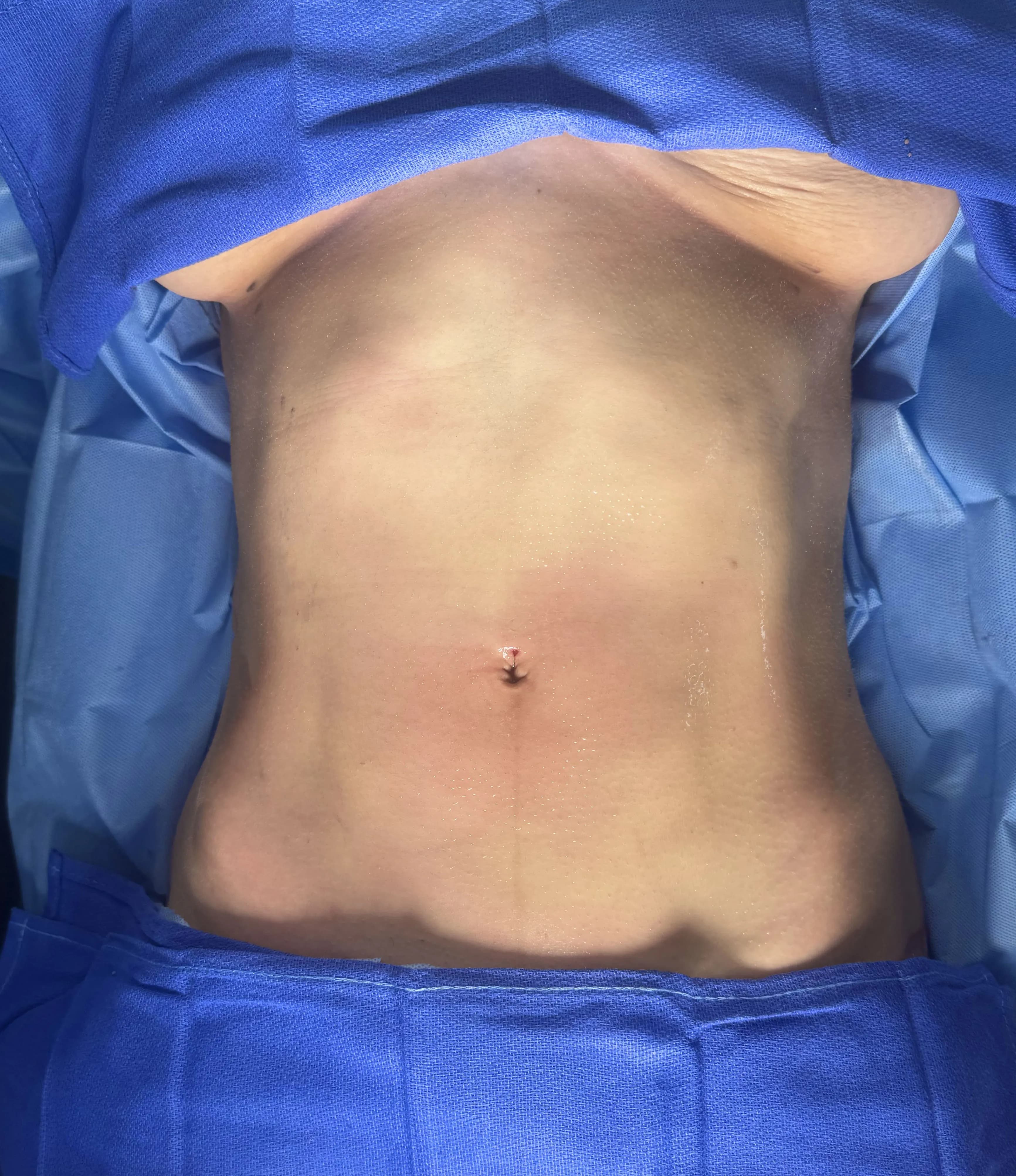 Liposuction & Lipo 360 after by Dr. Anne-Sophie Lessard in Miami · Beautyland Plastic Surgery
