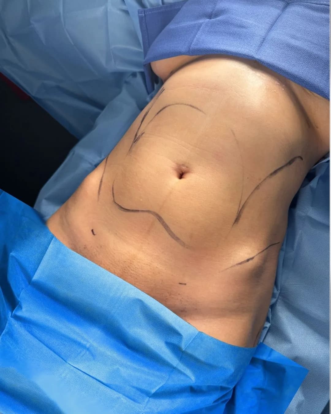 Liposuction & Lipo 360 before by Dr. Anne-Sophie Lessard in Miami · Beautyland Plastic Surgery