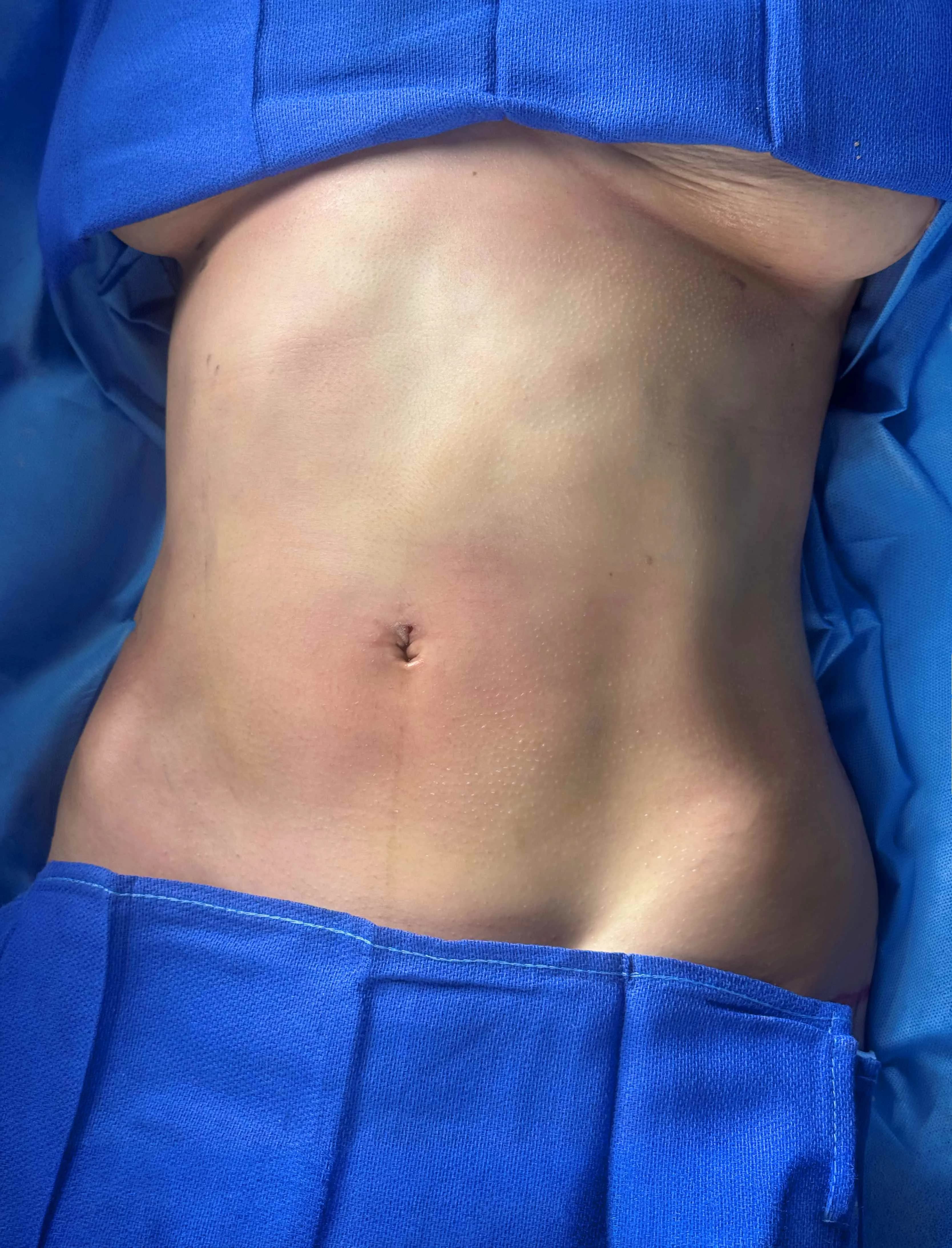 Liposuction & Lipo 360 after by Dr. Anne-Sophie Lessard in Miami · Beautyland Plastic Surgery