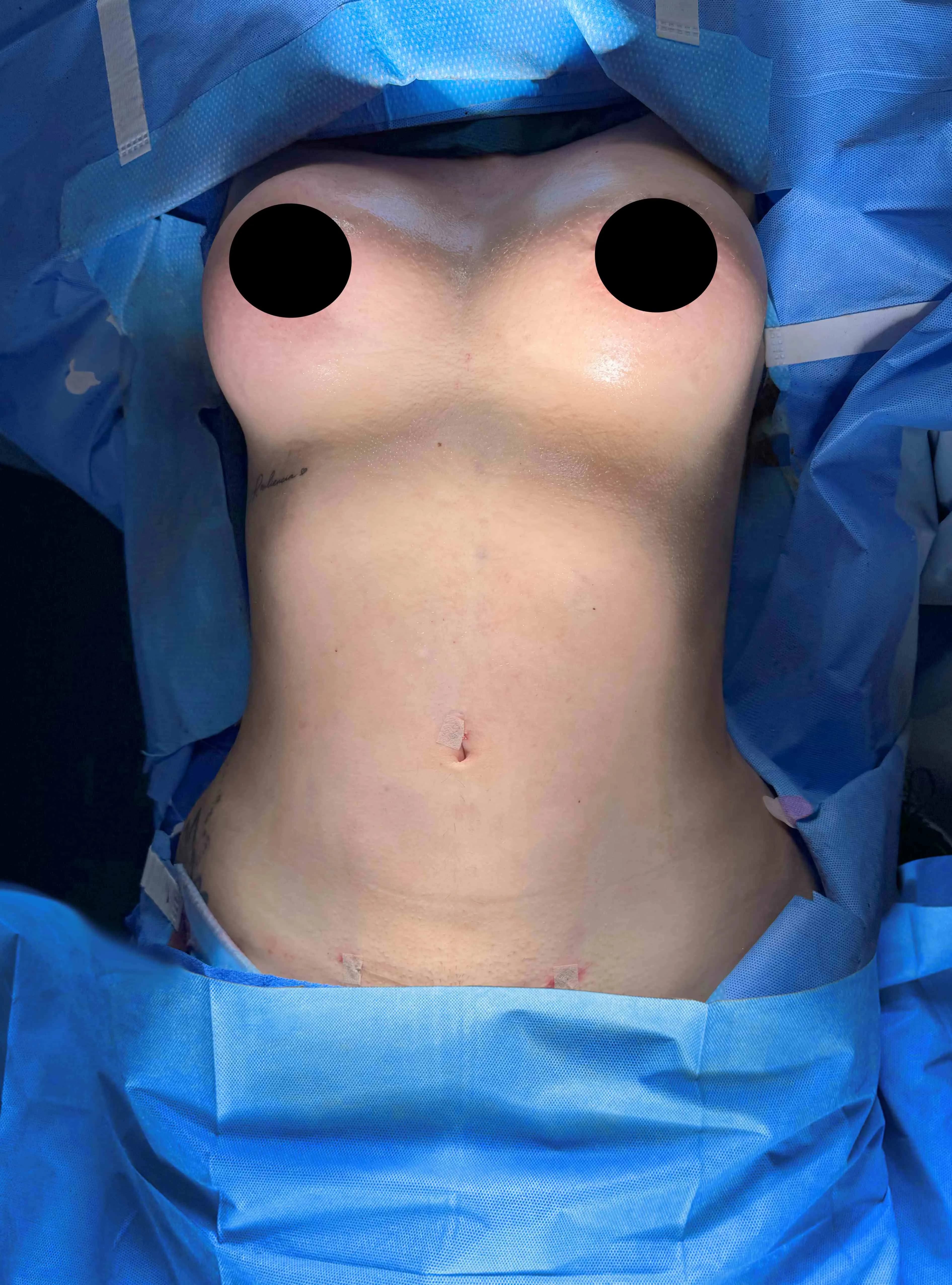 Liposuction & Lipo 360 after by Dr. Christopher J. Salgado in Miami · Beautyland Plastic Surgery