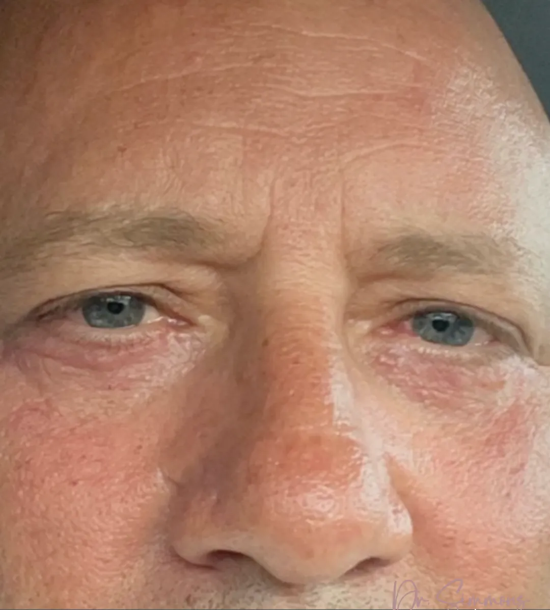 Face and neck procedures after by Dr. Oliver Simmons in Miami · Beautyland Plastic Surgery
