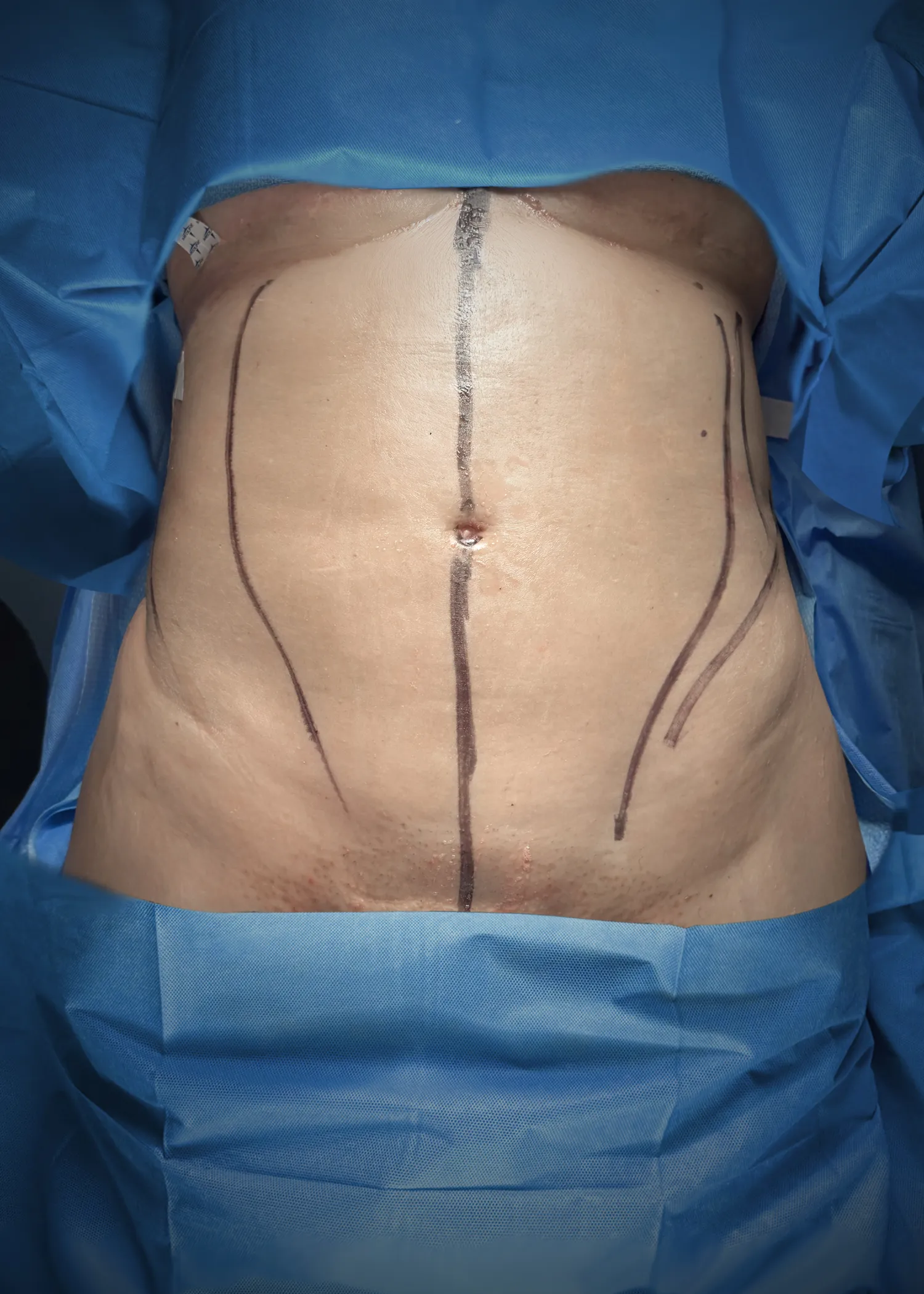 Liposuction & Lipo 360 before by Dr. Christopher J. Salgado in Miami · Beautyland Plastic Surgery