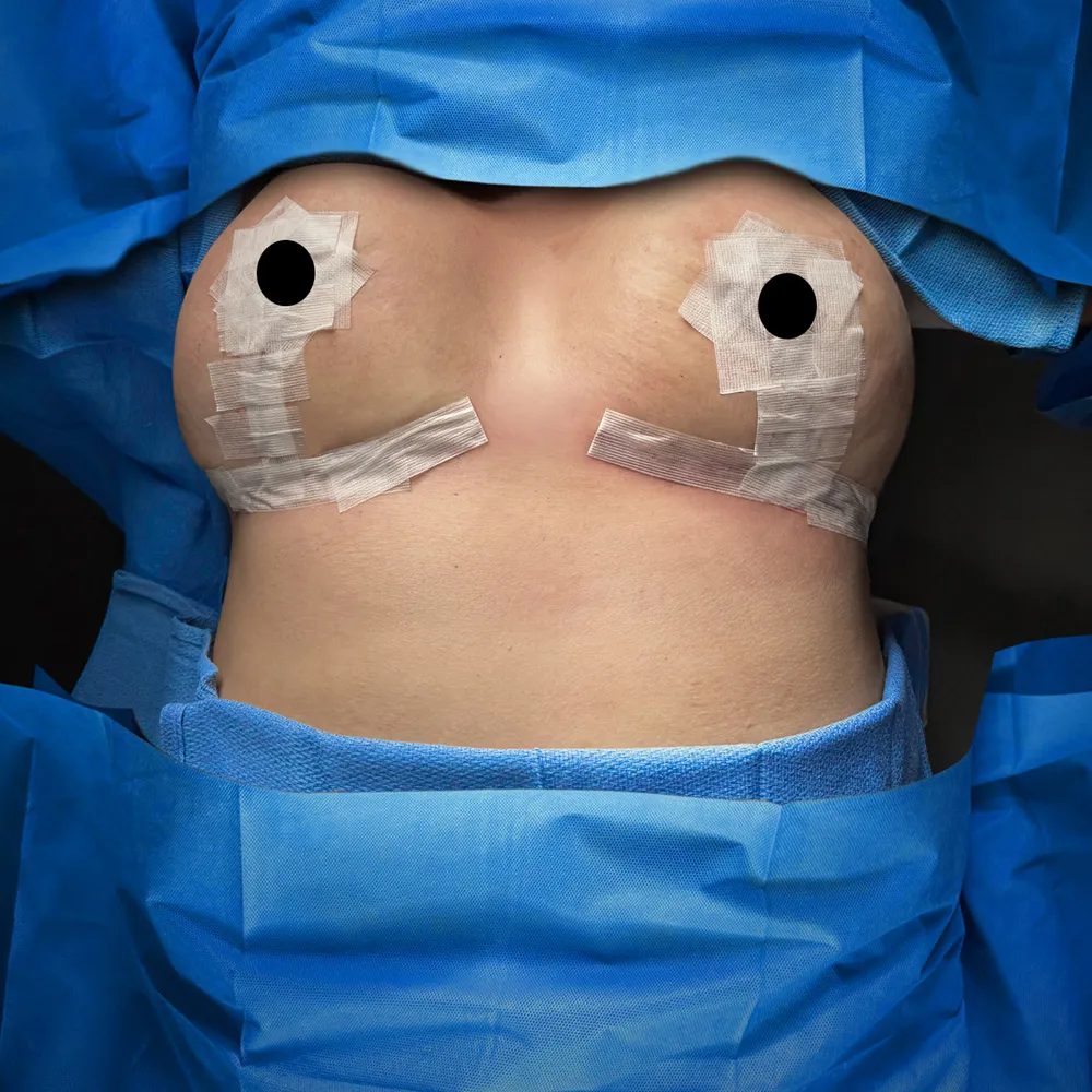 Breast Reduction after by Dr. Oliver Simmons in Miami · Beautyland Plastic Surgery