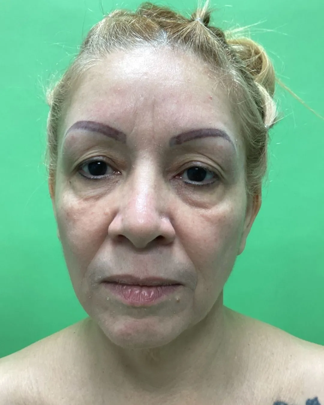 Rostro y cuello antes por Dr. Oliver Simmons en Miami · Beautyland Plastic Surgery
