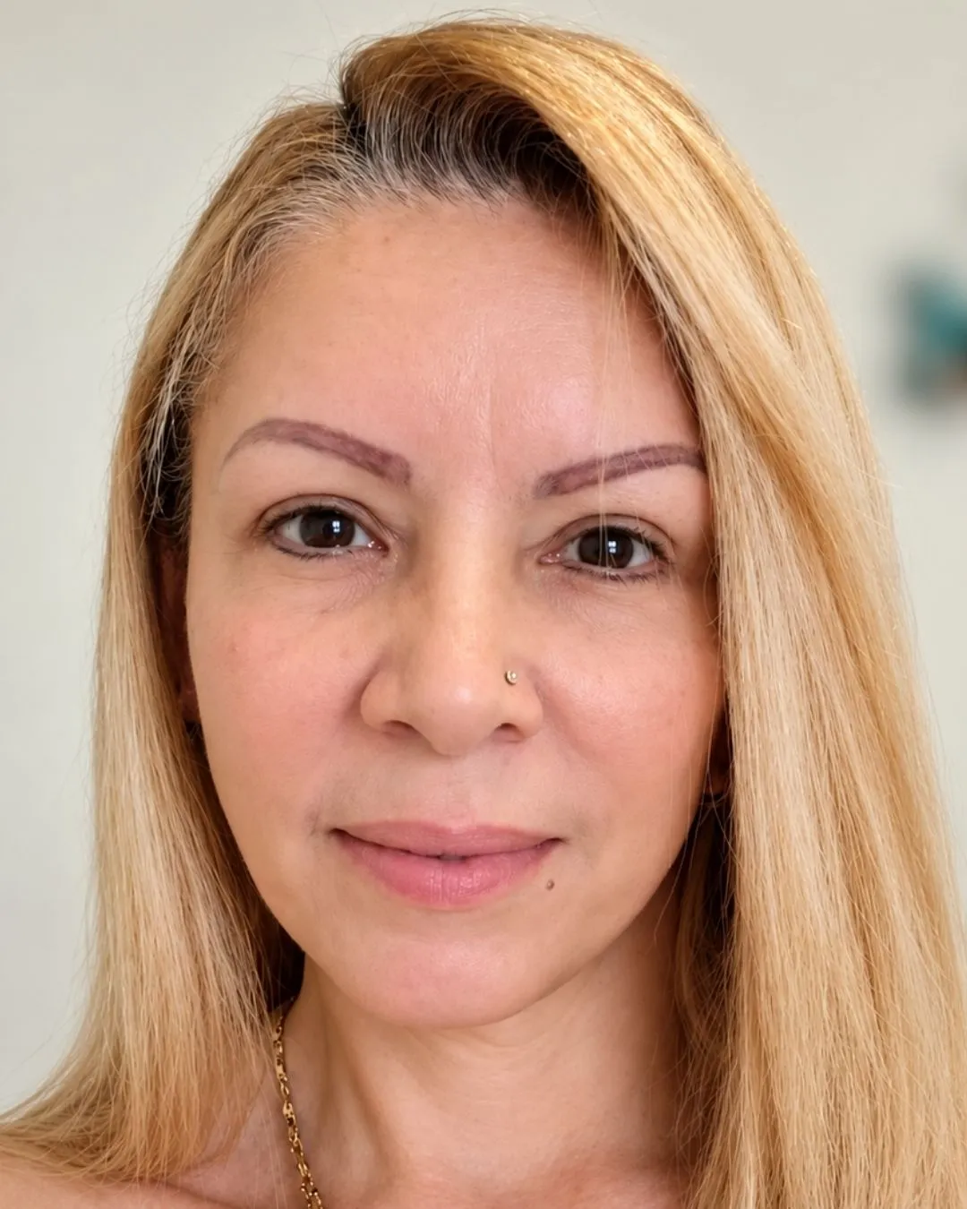 Rostro y cuello después por Dr. Oliver Simmons en Miami · Beautyland Plastic Surgery