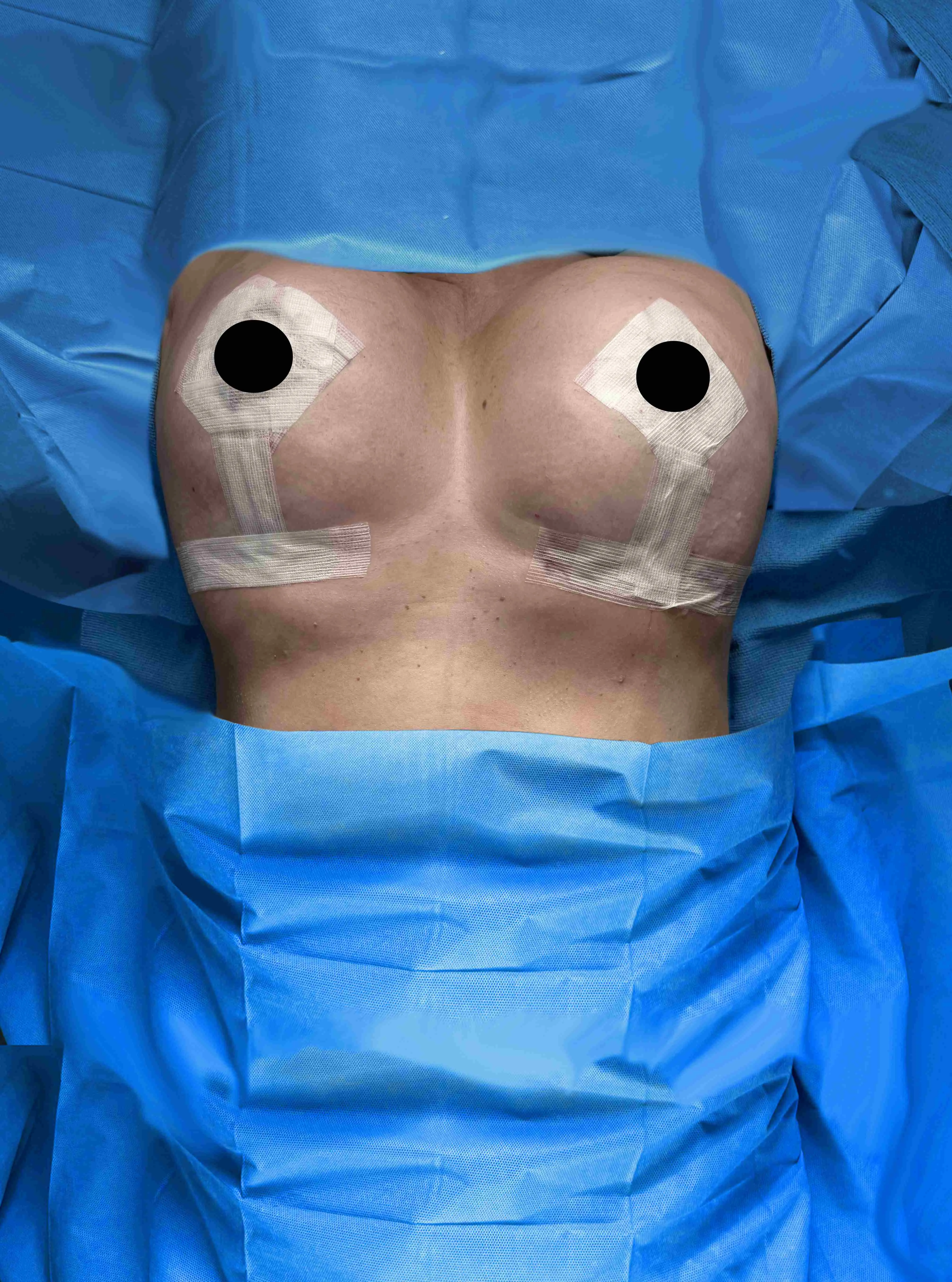 Breast Lift after by Dr. Anne-Sophie Lessard in Miami · Beautyland Plastic Surgery