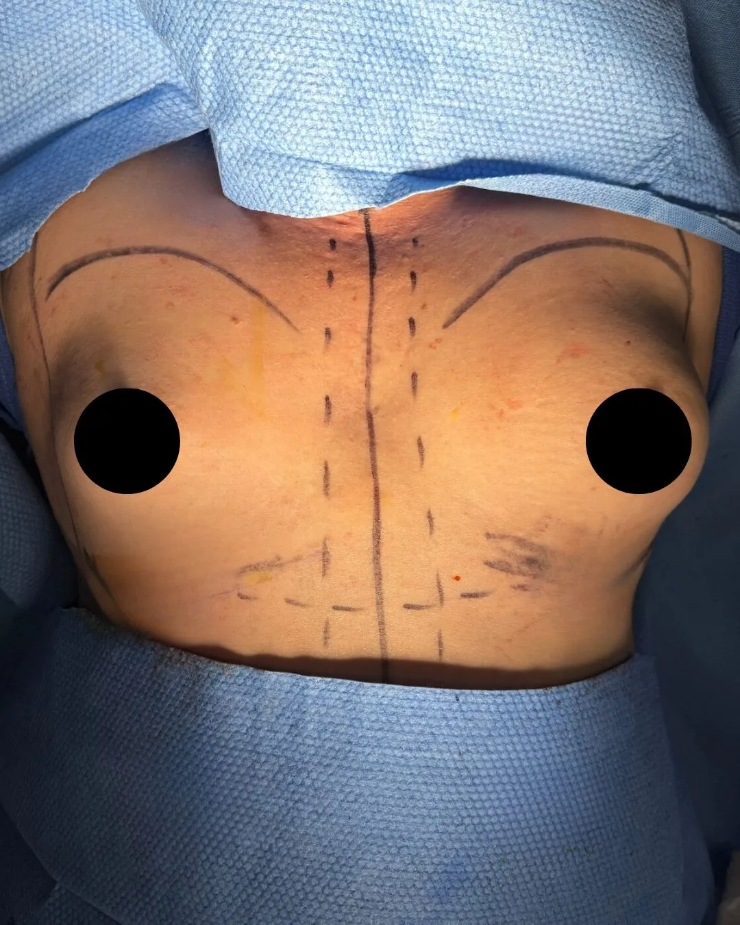 Breast Augmentation before by Dr. Anne-Sophie Lessard in Miami · Beautyland Plastic Surgery
