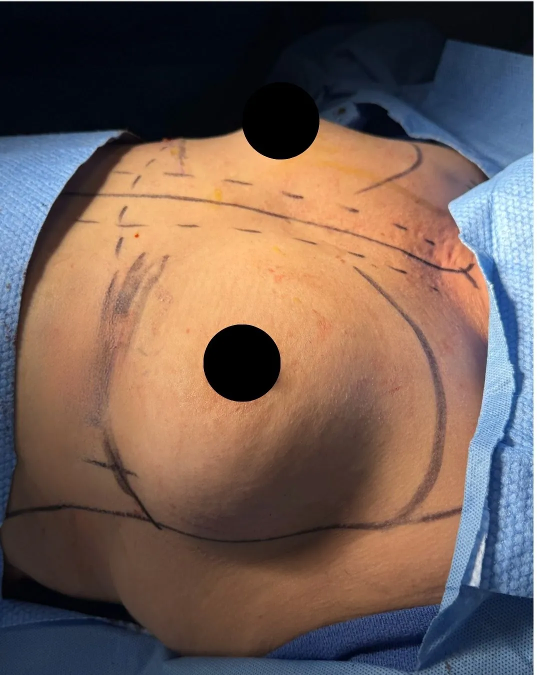 Breast Augmentation before by Dr. Anne-Sophie Lessard in Miami · Beautyland Plastic Surgery