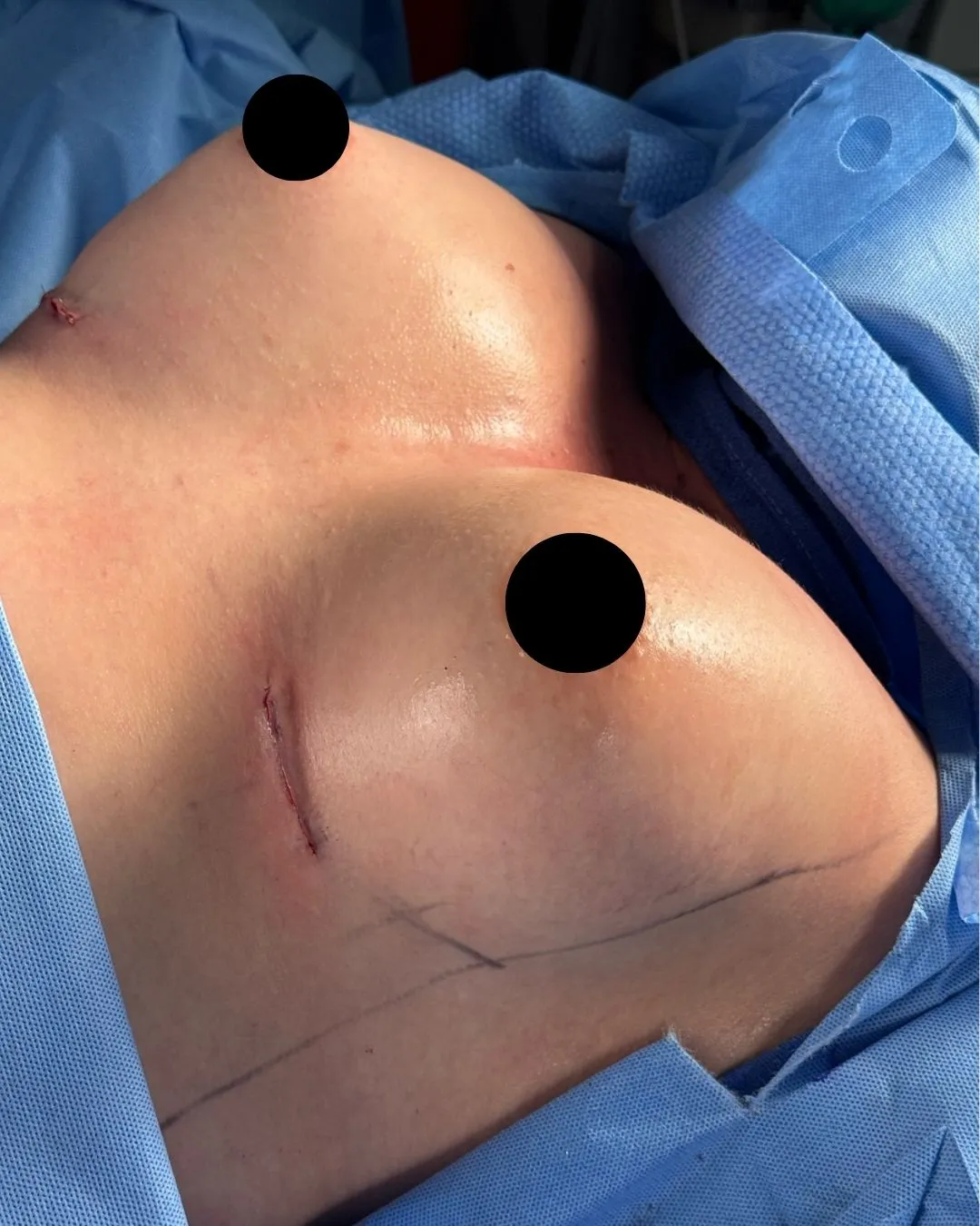 Breast Augmentation after by Dr. Anne-Sophie Lessard in Miami · Beautyland Plastic Surgery