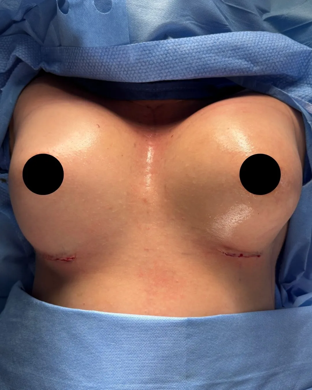 Breast Augmentation after by Dr. Anne-Sophie Lessard in Miami · Beautyland Plastic Surgery