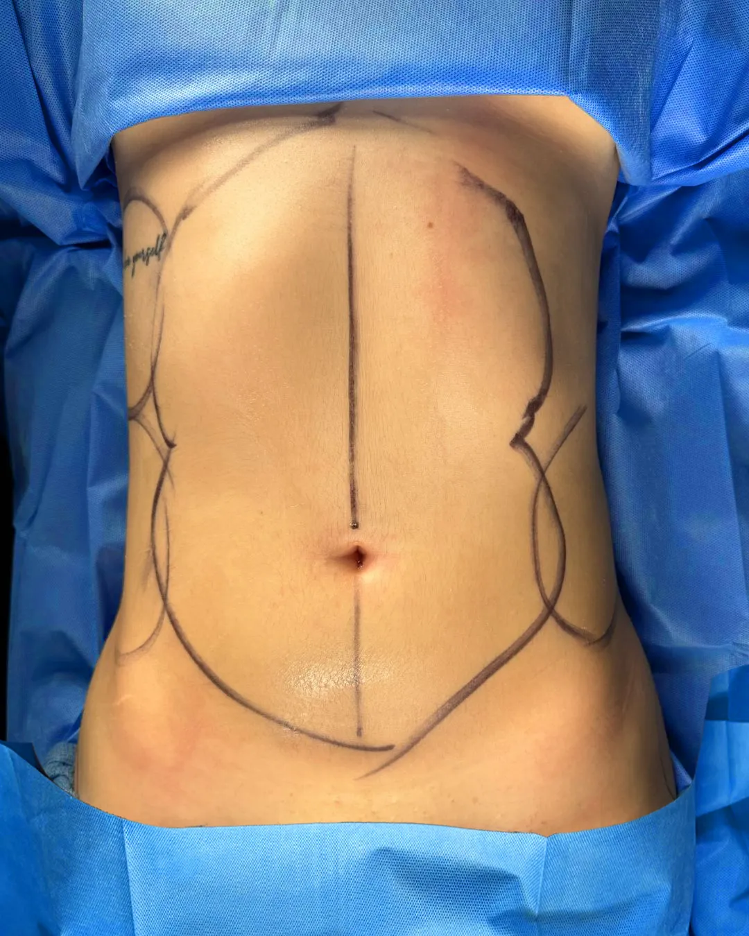 Liposuction & Lipo 360 before by Dr. Oliver Simmons in Miami · Beautyland Plastic Surgery