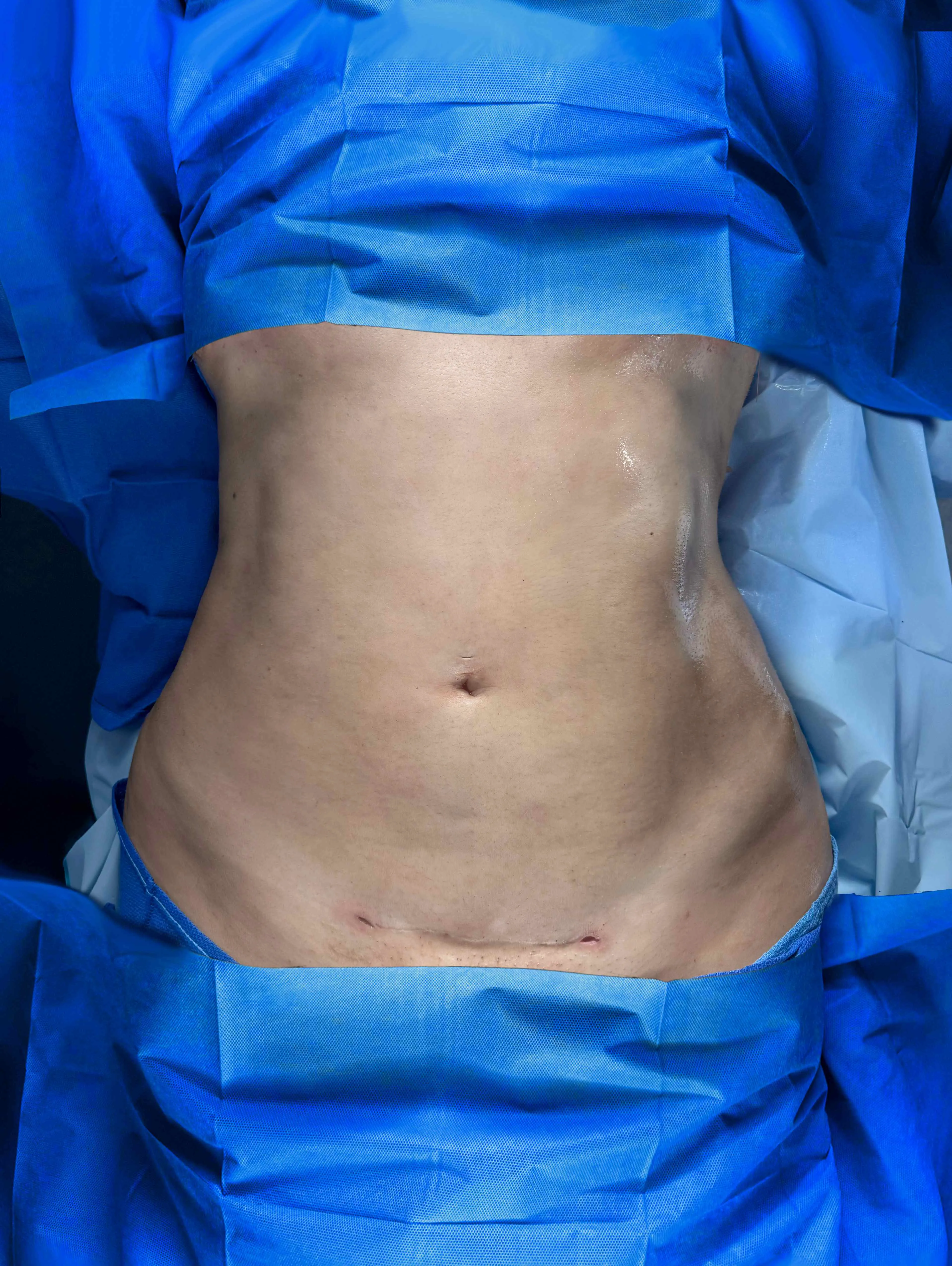Liposucción y Lipo 360 después por Dr. Oliver Simmons en Miami · Beautyland Plastic Surgery