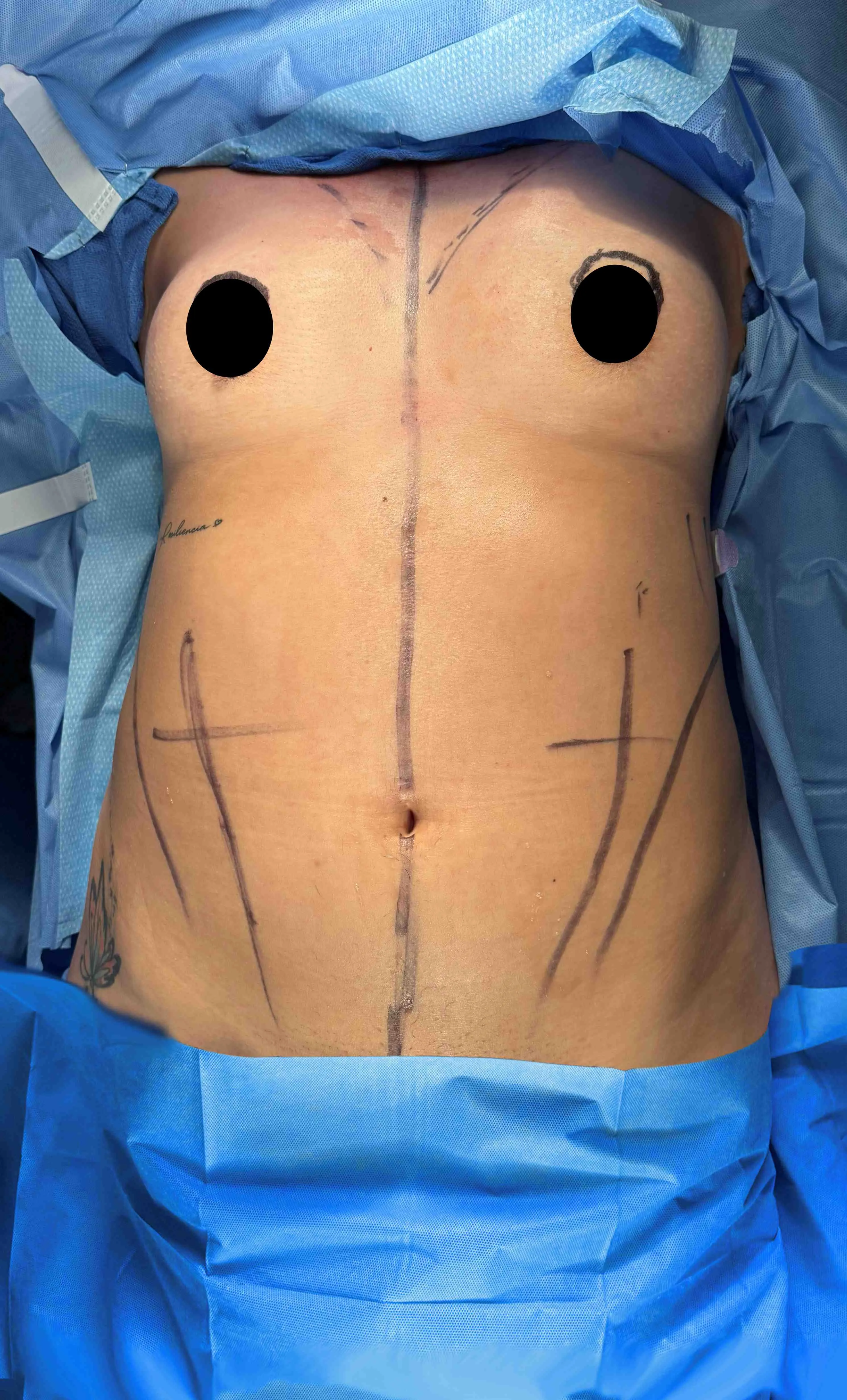 Liposuction & Lipo 360 before by Dr. Christopher J. Salgado in Miami · Beautyland Plastic Surgery
