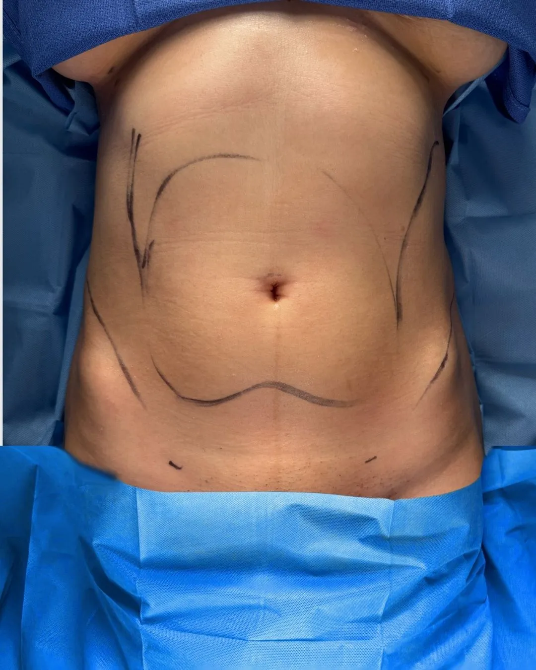 Liposuction & Lipo 360 before by Dr. Anne-Sophie Lessard in Miami · Beautyland Plastic Surgery