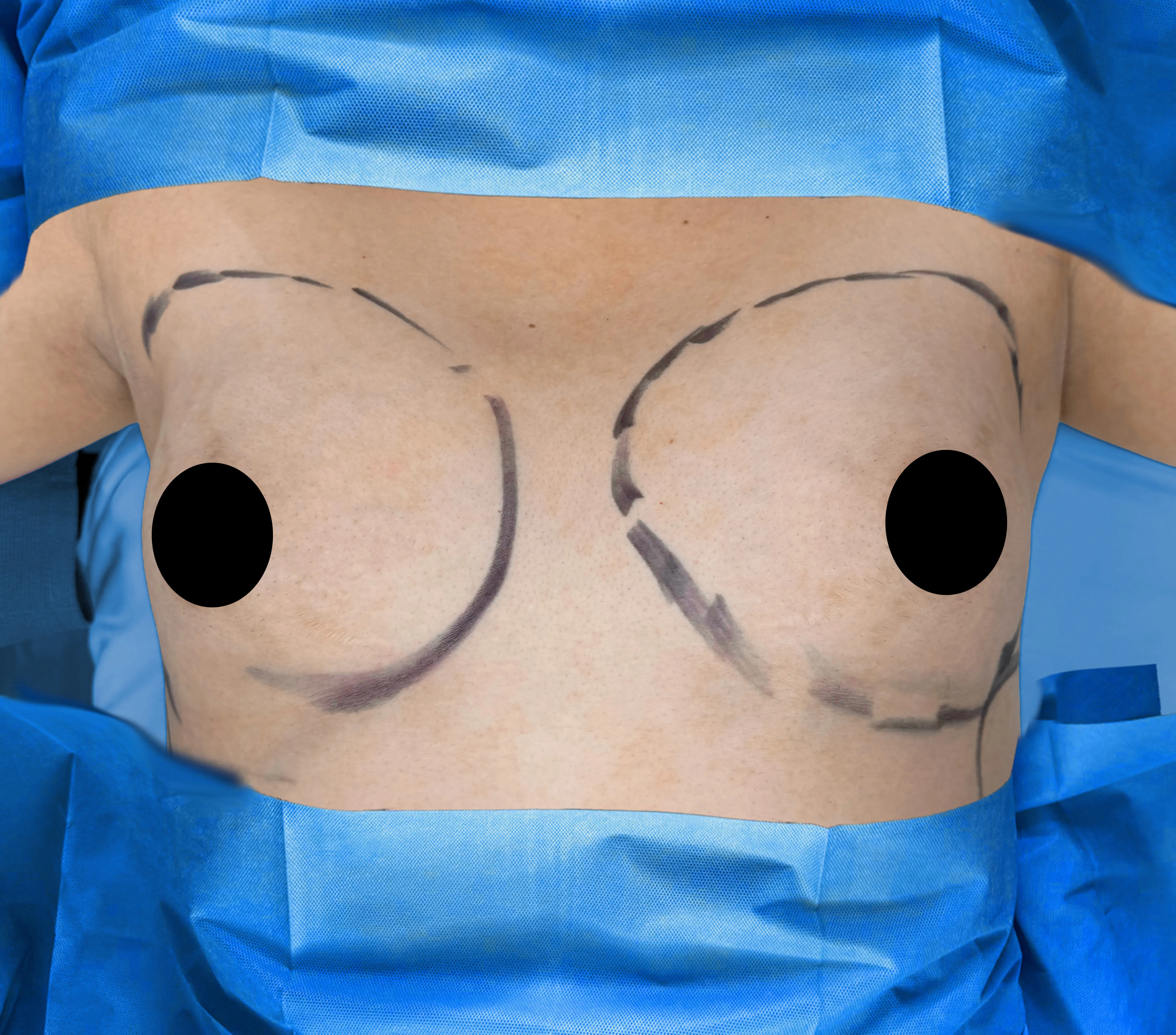 Breast Augmentation before by Dr. Anne-Sophie Lessard in Miami · Beautyland Plastic Surgery