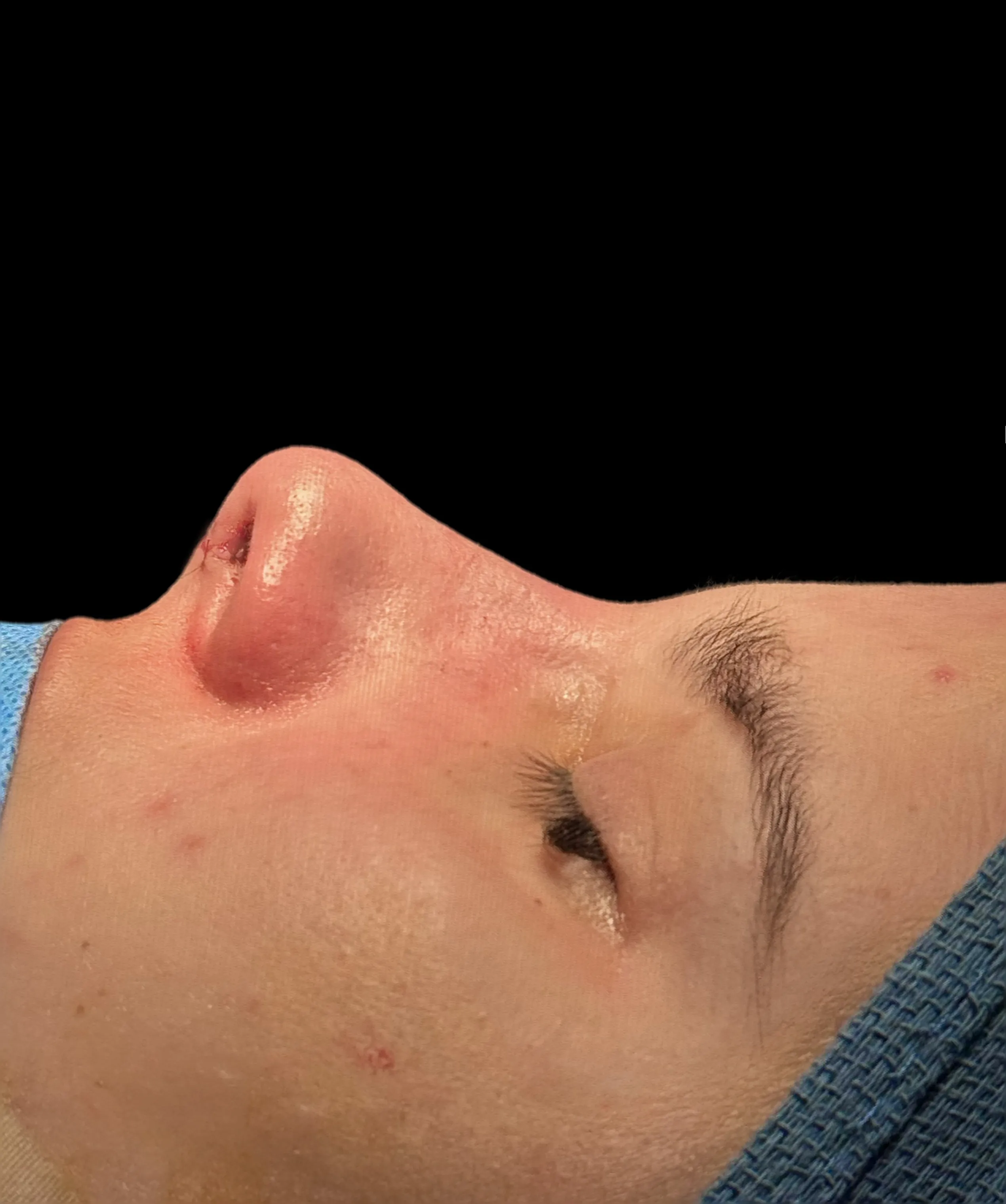 Rhinoplasty after by Dr. Oliver Simmons in Miami · Beautyland Plastic Surgery