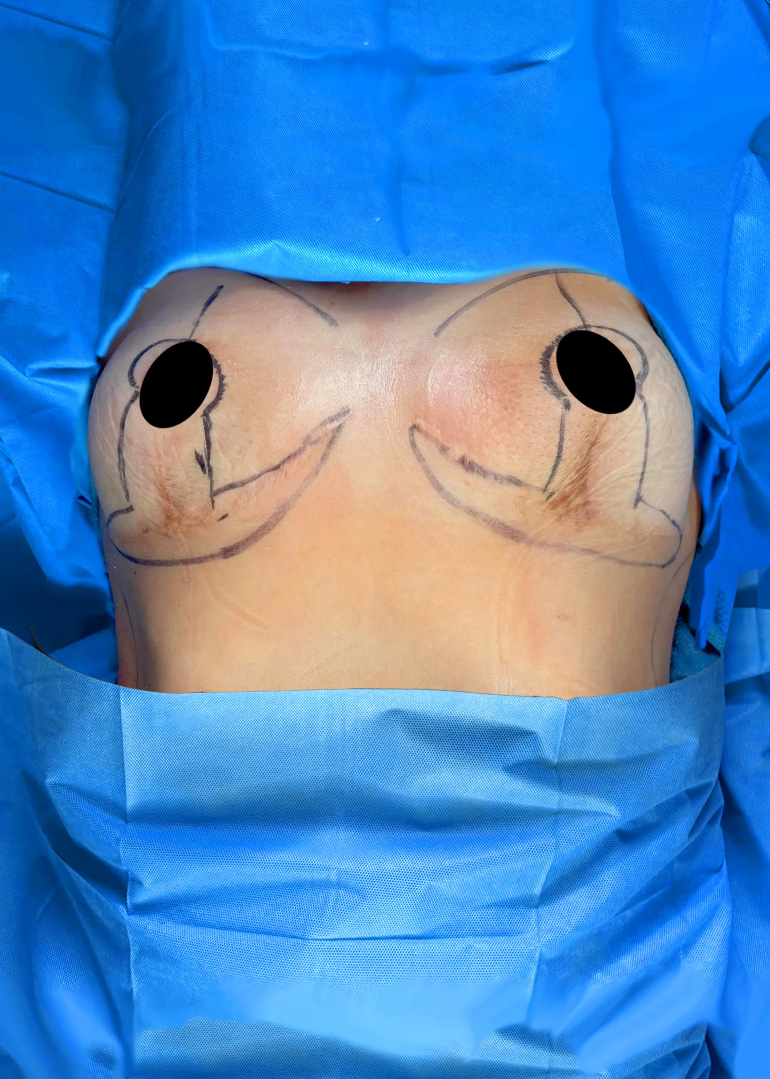 Breast Lift before by Dr. Oliver Simmons in Miami · Beautyland Plastic Surgery