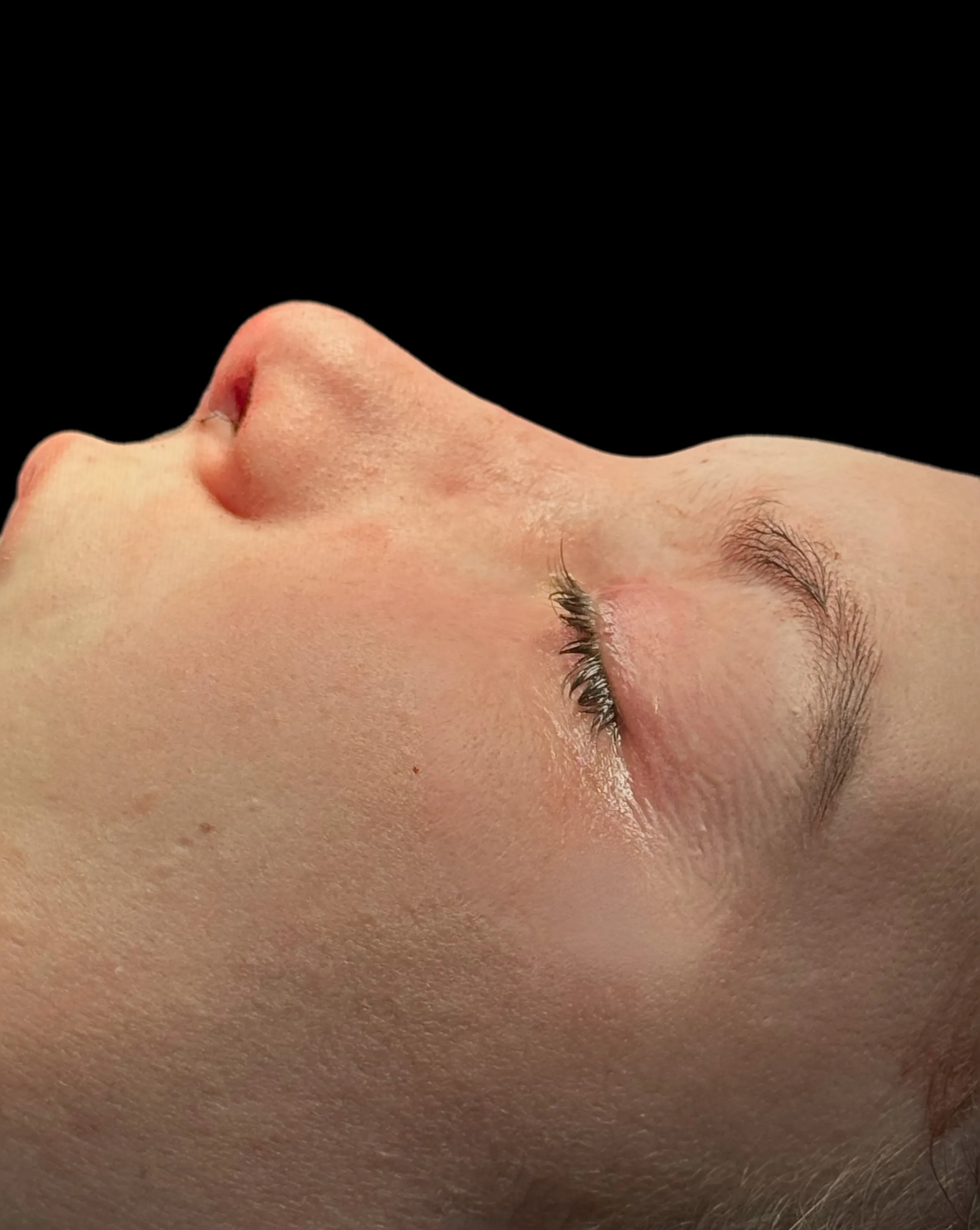Rhinoplasty after by Dr. Oliver Simmons in Miami · Beautyland Plastic Surgery