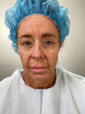 Face and neck procedures before by Dr. Oliver Simmons in Miami · Beautyland Plastic Surgery