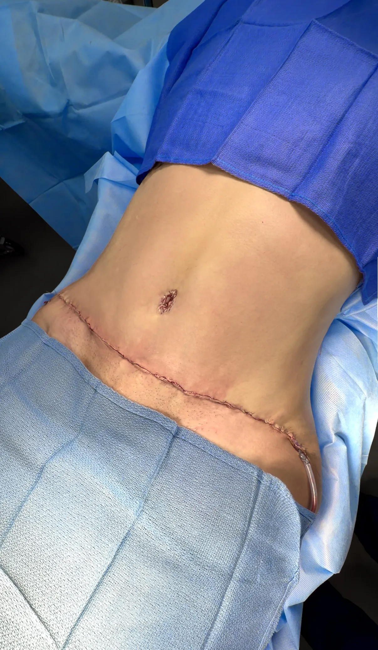 Tummy Tuck after by Dr. Oliver Simmons in Miami · Beautyland Plastic Surgery