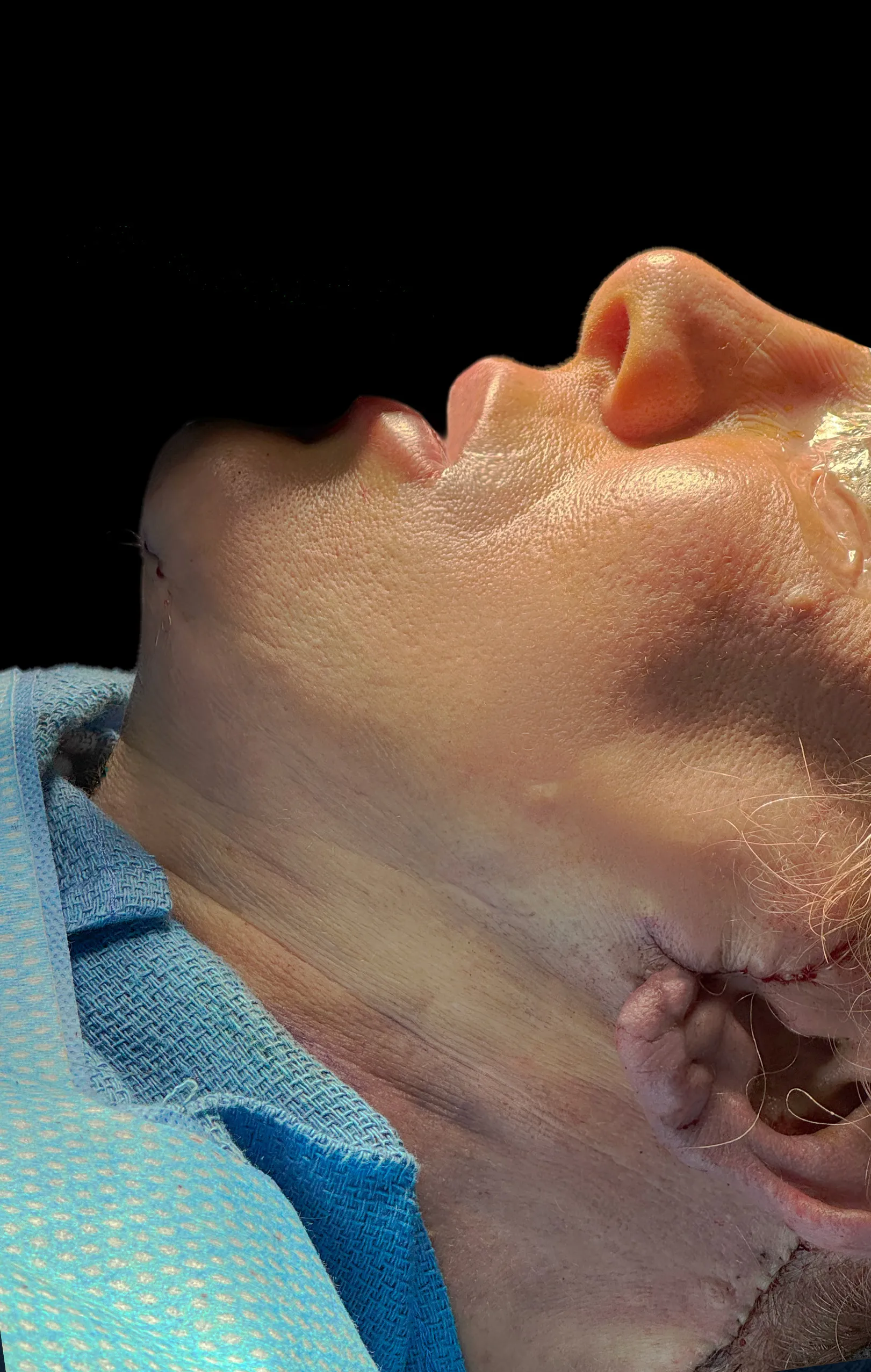 Rostro y cuello después por Dr. Oliver Simmons en Miami · Beautyland Plastic Surgery
