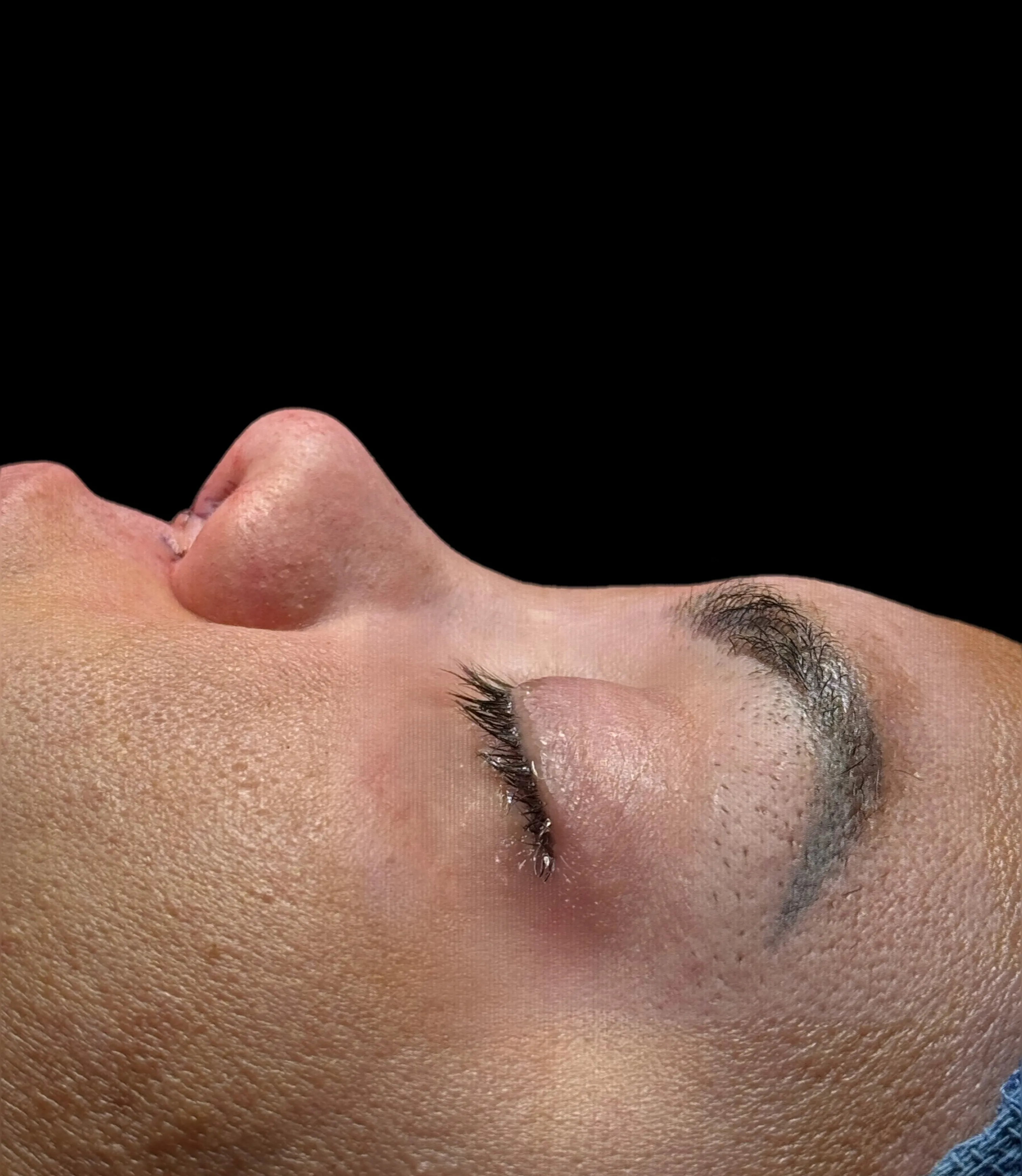 Rinoplastia después por Dr. Oliver Simmons en Miami · Beautyland Plastic Surgery