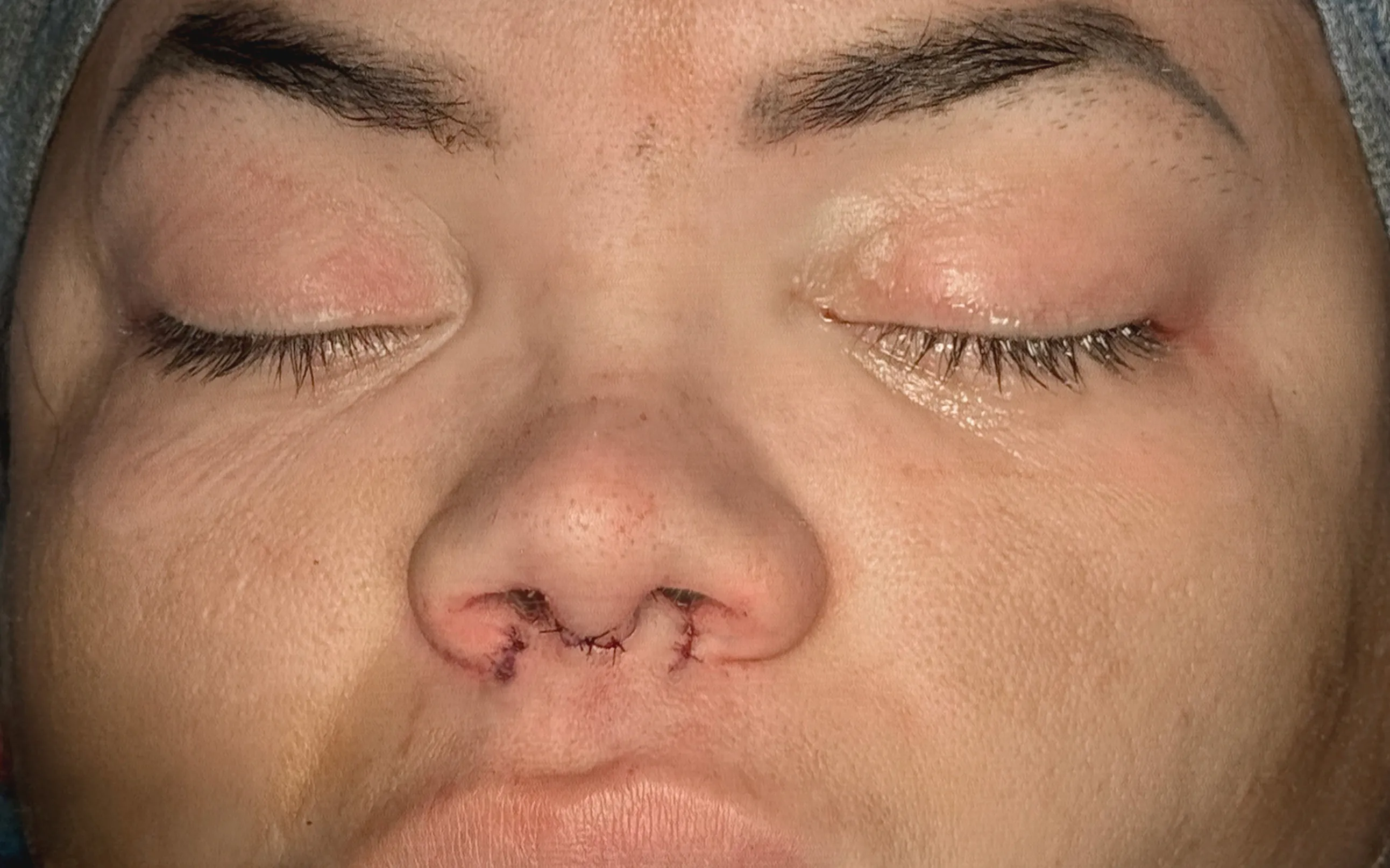 Rinoplastia después por Dr. Oliver Simmons en Miami · Beautyland Plastic Surgery