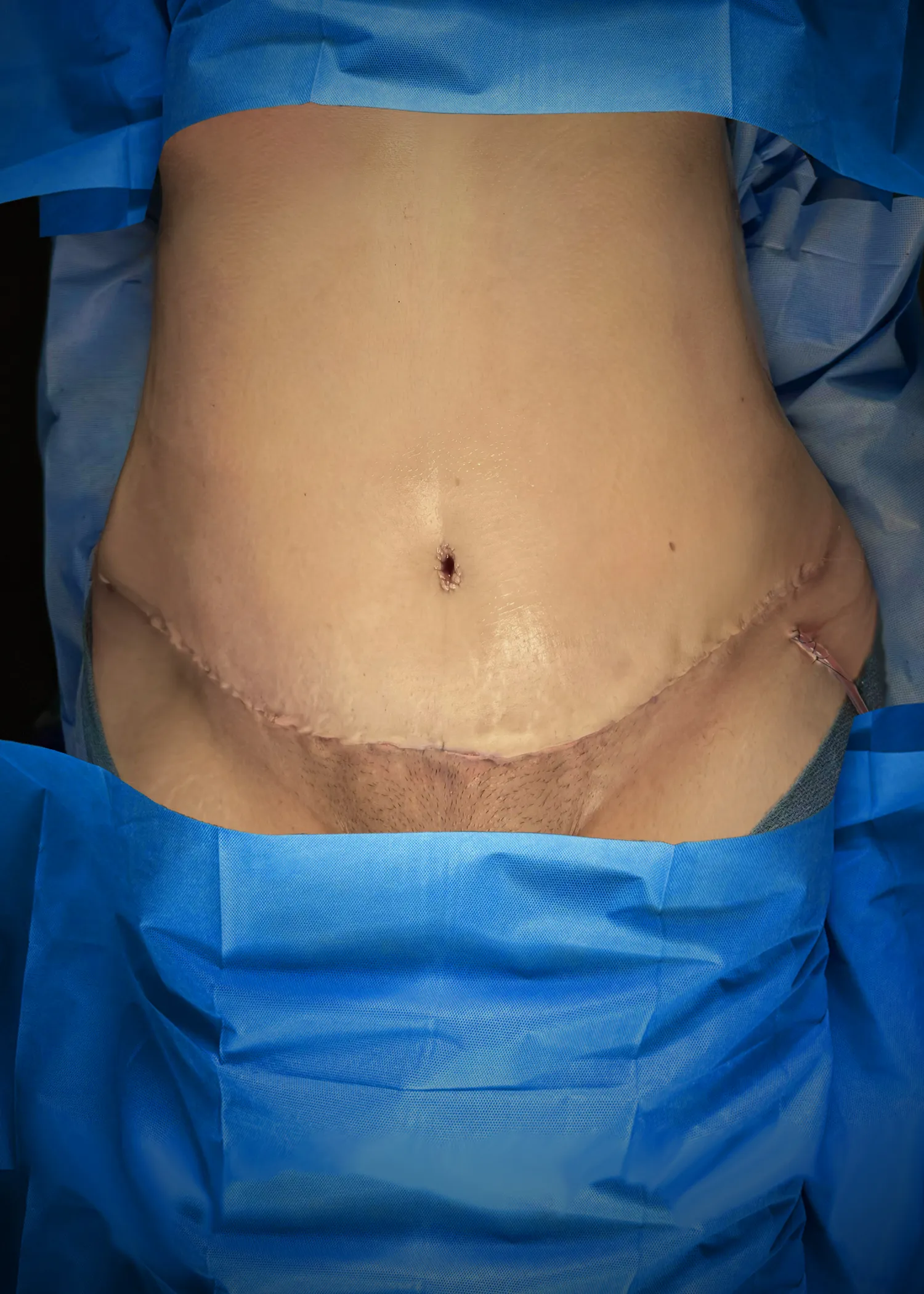 Tummy Tuck after by Dr. Anne-Sophie Lessard in Miami · Beautyland Plastic Surgery