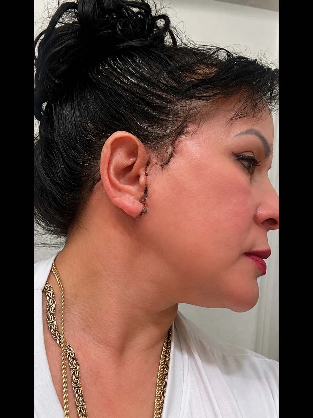 Face and neck procedures after by Dr. Oliver Simmons in Miami · Beautyland Plastic Surgery