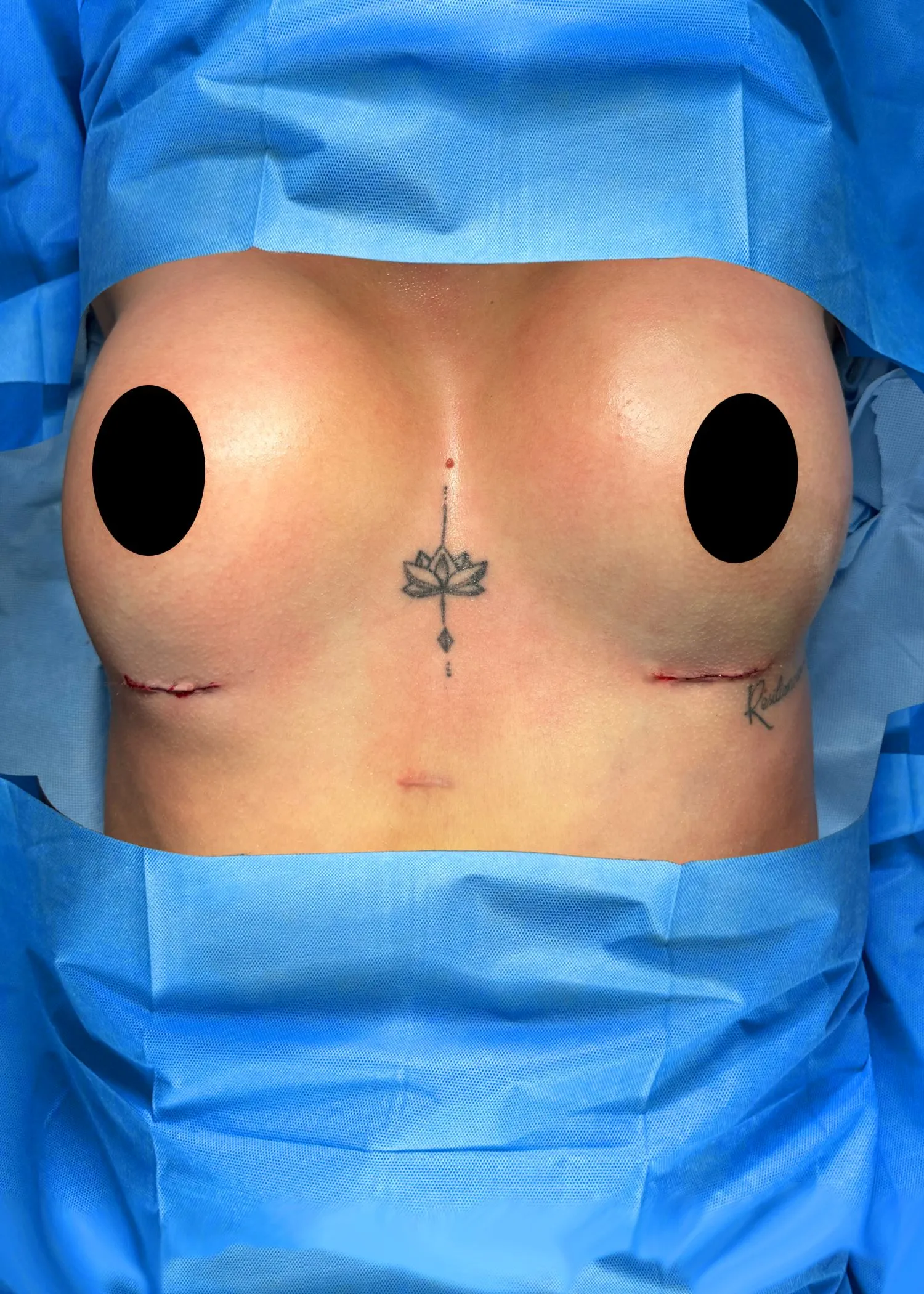 Breast Augmentation after by Dr. Oliver Simmons in Miami · Beautyland Plastic Surgery